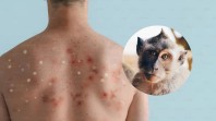 Hasil Labor Kemenkes, 2 Warga Kepulauan Meranti Negatif Virus Cacar Monyet